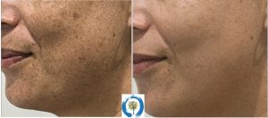 Laser Pigment Reduction