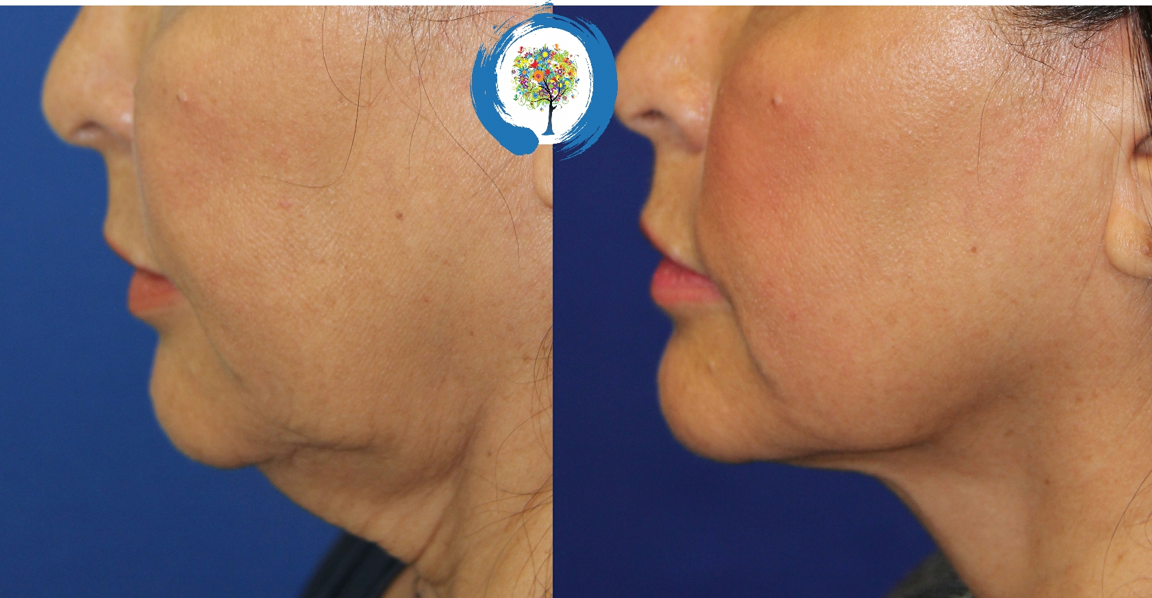 FaceTite Skin Tightening in Loveland and Fort Collins at Restore Beauty