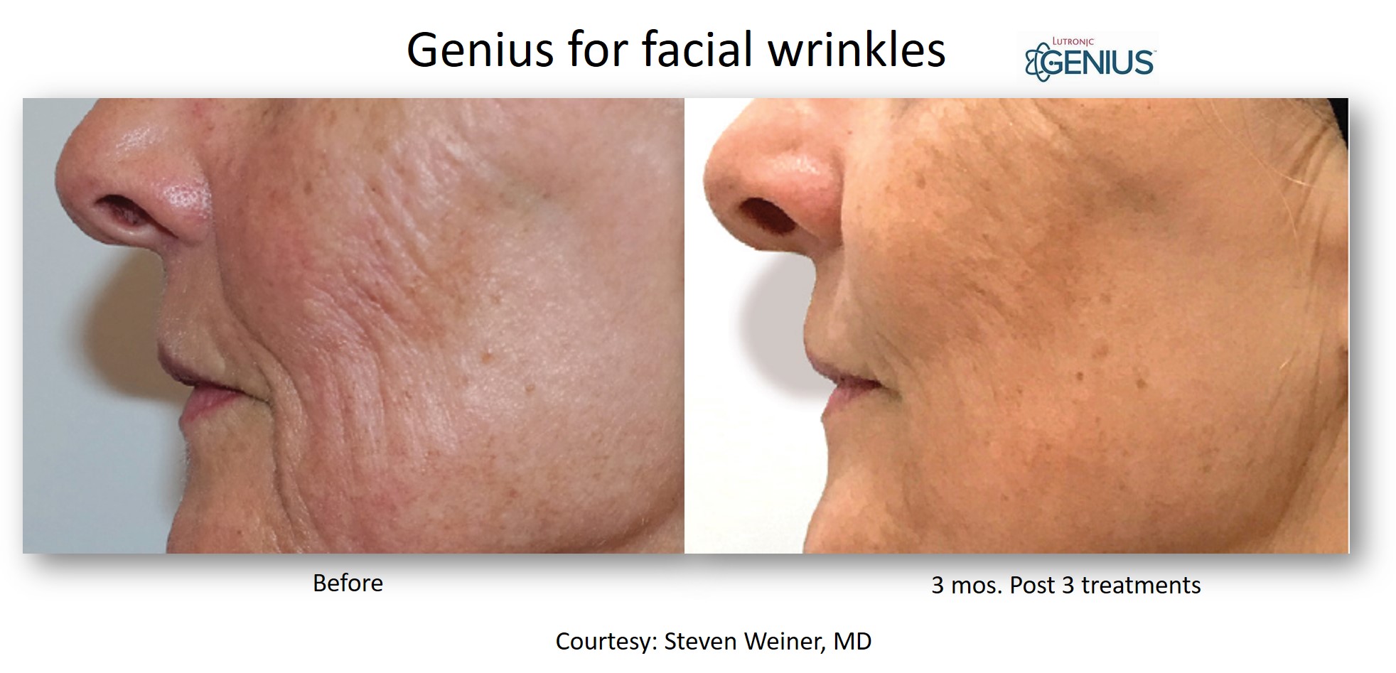Genius_Weiner_Facial Wrinkles